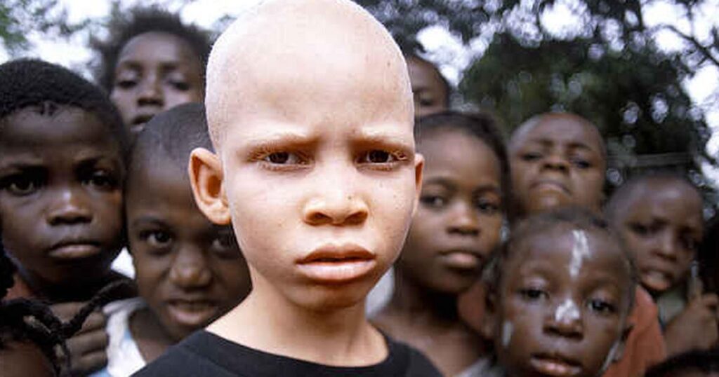 4 Mindless Myths About Albinos Ghanaians Should Stop Telling